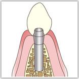インプラント