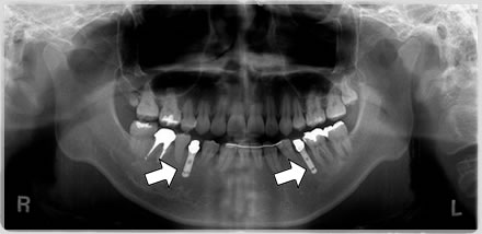 インプラントレントゲン写真