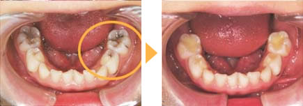 虫歯治療症例