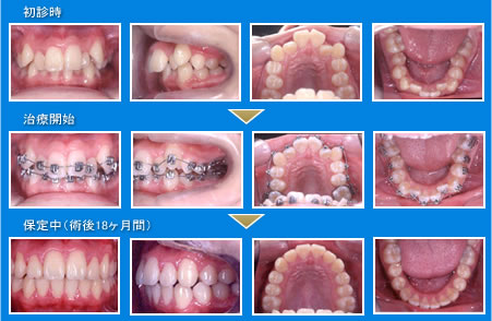 非抜歯治療写真
