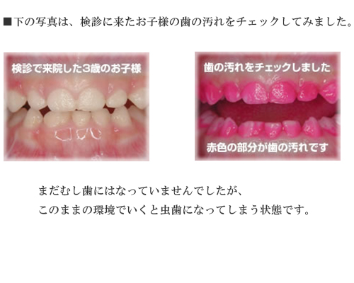 お口の中の細菌