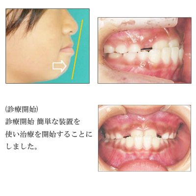 小児矯正